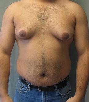 man boobs or gynecomastia